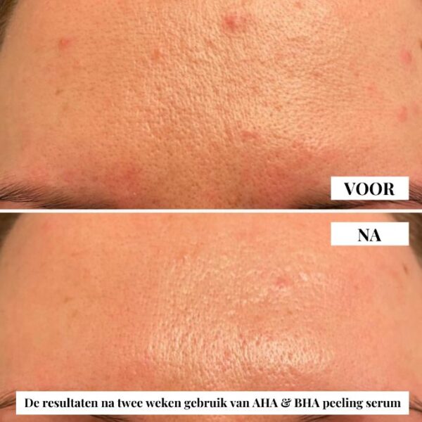 Flow Cosmetics – AHA & BHA Peeling Serum resultaten vergelijken