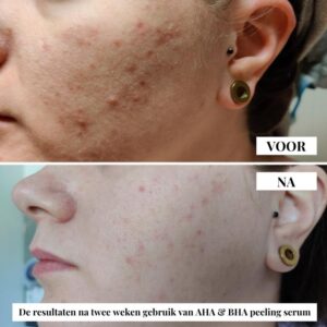 Flow Cosmetics – AHA & BHA Peeling Serum resultaten