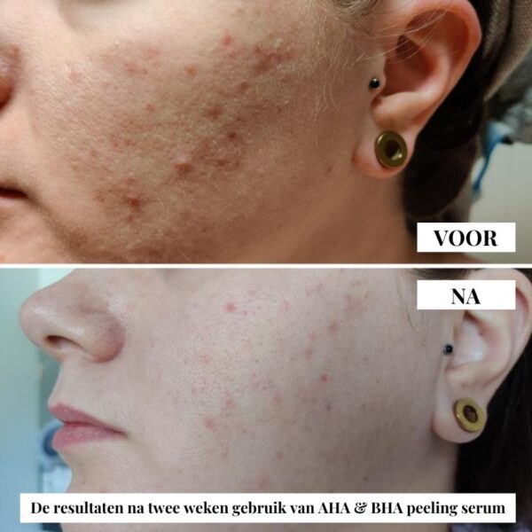 Flow Cosmetics – AHA & BHA Peeling Serum resultaten